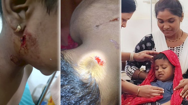 Bibttya attack | चिमुकल्यावर हल्ला, आईच्या धैर्यामुळे जीव वाचला